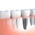 Ensuring Dental Safety During Dental Implant Procedures In Round Rock