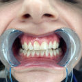 Prioritize Dental Safety When Considering Teeth Whitening Costs in Ottawa