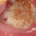 What are the Most Common Complications After Tooth Extraction? A Comprehensive Guide