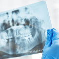 The Benefits of Dental X-Rays: A Comprehensive Guide