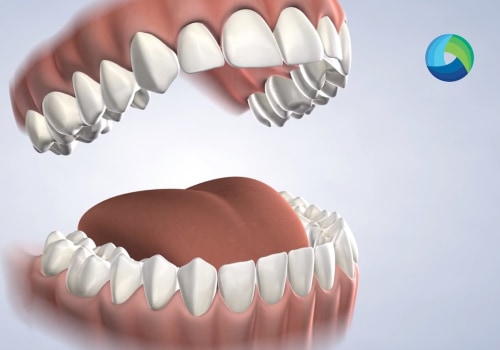 Post-Operative Care for a Successful Recovery After Dental Surgery