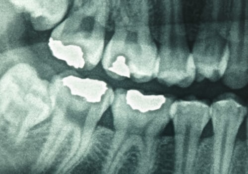 Safety Precautions for Dental X-Rays: What You Need to Know