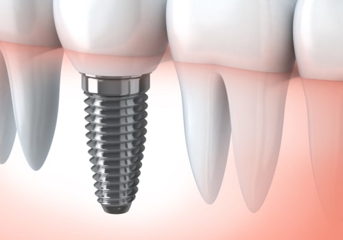Ensuring Dental Safety During Dental Implant Procedures In Round Rock
