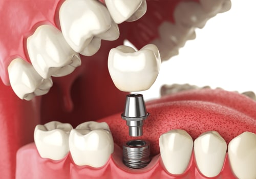 The Importance Of Choosing A Safe Dental Implant Provider In Canberra
