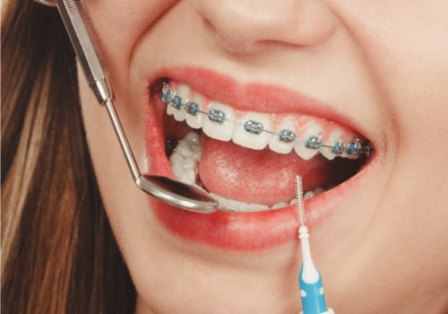 Ensuring Dental Safety with Braces in Stafford, VA