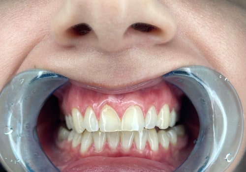 Prioritize Dental Safety When Considering Teeth Whitening Costs in Ottawa