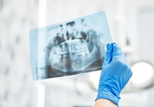 The Benefits of Dental X-Rays: A Comprehensive Guide